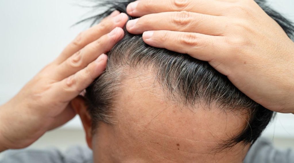 Caída del cabello: ¿Cuándo es momento de acudir al dermatólogo?