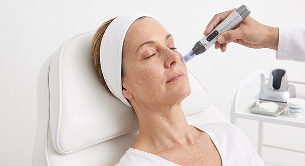 microneedling 2 dermatologo zona 1